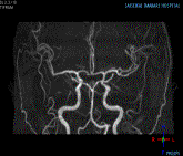 MRI