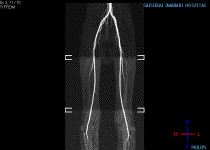 MRI