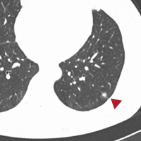 肺がん画像1