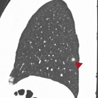 肺がん画像3