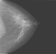 正常な乳房Ｘ線