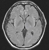 正常な方のＭＲＩ