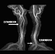 頸動脈狭窄症の頸部ＭＲＡ