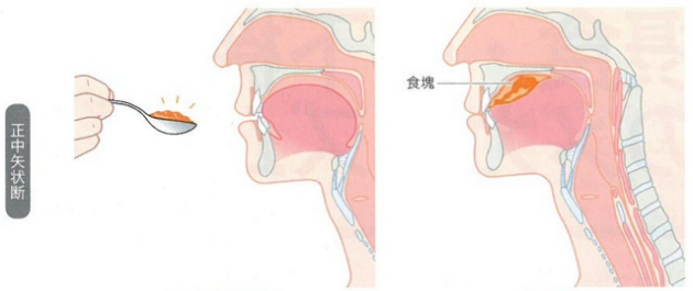 嚥下障害の画像1