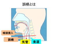 誤嚥とはの画像