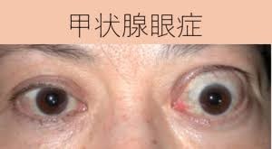 甲状腺眼症1